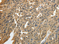 The image on the left is immunohistochemistry of paraffin-embedded Human ovarian cancer tissue using CSB-PA910911(GSR Antibody) at dilution 1/50, on the right is treated with fusion protein. (Original magnification: ×200)