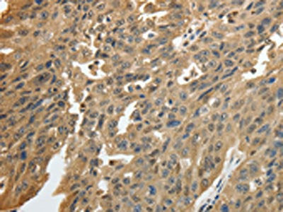 The image on the left is immunohistochemistry of paraffin-embedded Human ovarian cancer tissue using CSB-PA910911(GSR Antibody) at dilution 1/50, on the right is treated with fusion protein. (Original magnification: ×200)