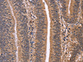 The image on the left is immunohistochemistry of paraffin-embedded Human colon cancer tissue using CSB-PA911084(CLUAP1 Antibody) at dilution 1/50, on the right is treated with fusion protein. (Original magnification: ×200)