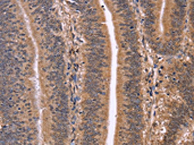 The image on the left is immunohistochemistry of paraffin-embedded Human colon cancer tissue using CSB-PA911084(CLUAP1 Antibody) at dilution 1/50, on the right is treated with fusion protein. (Original magnification: ×200)