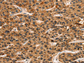 The image on the left is immunohistochemistry of paraffin-embedded Human liver cancer tissue using CSB-PA911316(KLRC1 Antibody) at dilution 1/30, on the right is treated with fusion protein. (Original magnification: ×200)