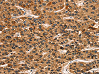 The image on the left is immunohistochemistry of paraffin-embedded Human liver cancer tissue using CSB-PA911316(KLRC1 Antibody) at dilution 1/30, on the right is treated with fusion protein. (Original magnification: ×200)