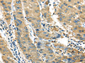 The image on the left is immunohistochemistry of paraffin-embedded Human liver cancer tissue using CSB-PA911335(IL3RA Antibody) at dilution 1/35, on the right is treated with synthetic peptide. (Original magnification: ×200)