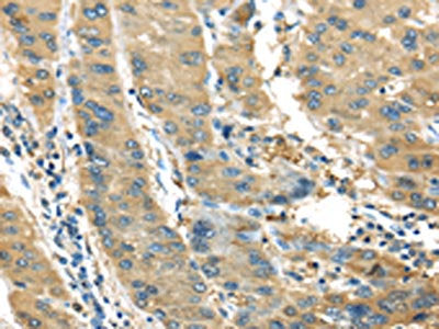 The image on the left is immunohistochemistry of paraffin-embedded Human liver cancer tissue using CSB-PA911335(IL3RA Antibody) at dilution 1/35, on the right is treated with synthetic peptide. (Original magnification: ×200)