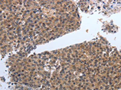 The image on the left is immunohistochemistry of paraffin-embedded Human liver cancer tissue using CSB-PA911363(PDGFB Antibody) at dilution 1/40, on the right is treated with synthetic peptide. (Original magnification: ×200)