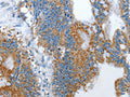 The image on the left is immunohistochemistry of paraffin-embedded Human colon cancer tissue using CSB-PA911568(RARRES3 Antibody) at dilution 1/25, on the right is treated with fusion protein. (Original magnification: ×200)