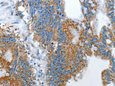 The image on the left is immunohistochemistry of paraffin-embedded Human colon cancer tissue using CSB-PA911568(RARRES3 Antibody) at dilution 1/25, on the right is treated with fusion protein. (Original magnification: ×200)