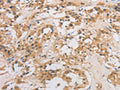 The image on the left is immunohistochemistry of paraffin-embedded Human thyroid cancer tissue using CSB-PA911773(DCTN5 Antibody) at dilution 1/20, on the right is treated with fusion protein. (Original magnification: ×200)