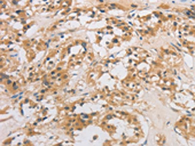 The image on the left is immunohistochemistry of paraffin-embedded Human thyroid cancer tissue using CSB-PA911773(DCTN5 Antibody) at dilution 1/20, on the right is treated with fusion protein. (Original magnification: ×200)