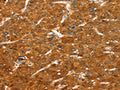 The image on the left is immunohistochemistry of paraffin-embedded Human liver cancer tissue using CSB-PA911864(COLEC11 Antibody) at dilution 1/20, on the right is treated with fusion protein. (Original magnification: ×200)