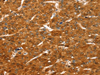 The image on the left is immunohistochemistry of paraffin-embedded Human liver cancer tissue using CSB-PA911864(COLEC11 Antibody) at dilution 1/20, on the right is treated with fusion protein. (Original magnification: ×200)