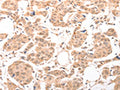 The image on the left is immunohistochemistry of paraffin-embedded Human breast cancer tissue using CSB-PA911950(ACIN1 Antibody) at dilution 1/30, on the right is treated with synthetic peptide. (Original magnification: ×200)