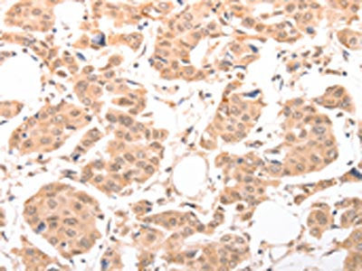 The image on the left is immunohistochemistry of paraffin-embedded Human breast cancer tissue using CSB-PA911950(ACIN1 Antibody) at dilution 1/30, on the right is treated with synthetic peptide. (Original magnification: ×200)