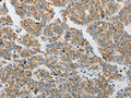 The image on the left is immunohistochemistry of paraffin-embedded Human liver cancer tissue using CSB-PA912013(PRDX1 Antibody) at dilution 1/20, on the right is treated with synthetic peptide. (Original magnification: ×200)