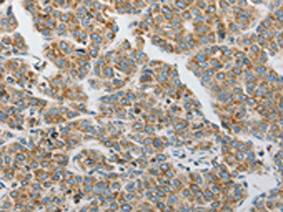 The image on the left is immunohistochemistry of paraffin-embedded Human liver cancer tissue using CSB-PA912013(PRDX1 Antibody) at dilution 1/20, on the right is treated with synthetic peptide. (Original magnification: ×200)