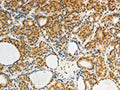 The image on the left is immunohistochemistry of paraffin-embedded Human thyroid cancer tissue using CSB-PA912094(AKR1A1 Antibody) at dilution 1/25, on the right is treated with synthetic peptide. (Original magnification: ×200)
