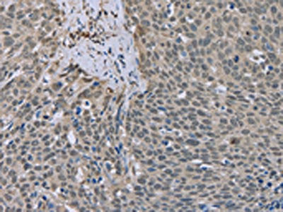 The image on the left is immunohistochemistry of paraffin-embedded Human cervical cancer tissue using CSB-PA912176(ESR2 Antibody) at dilution 1/20, on the right is treated with fusion protein. (Original magnification: ×200)