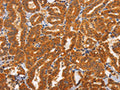 The image on the left is immunohistochemistry of paraffin-embedded Human thyroid cancer tissue using CSB-PA912411(TNFRSF8 Antibody) at dilution 1/60, on the right is treated with synthetic peptide. (Original magnification: ×200)