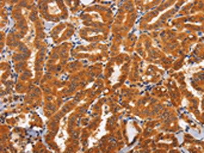 The image on the left is immunohistochemistry of paraffin-embedded Human thyroid cancer tissue using CSB-PA912411(TNFRSF8 Antibody) at dilution 1/60, on the right is treated with synthetic peptide. (Original magnification: ×200)