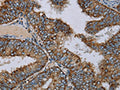 The image on the left is immunohistochemistry of paraffin-embedded Human colon cancer tissue using CSB-PA912628(NDUFA9 Antibody) at dilution 1/30, on the right is treated with fusion protein. (Original magnification: ×200)