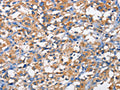 The image on the left is immunohistochemistry of paraffin-embedded Human thyroid cancer tissue using CSB-PA912667(PFKP Antibody) at dilution 1/50, on the right is treated with fusion protein. (Original magnification: ×200)