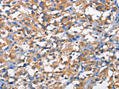 The image on the left is immunohistochemistry of paraffin-embedded Human thyroid cancer tissue using CSB-PA912667(PFKP Antibody) at dilution 1/50, on the right is treated with fusion protein. (Original magnification: ×200)