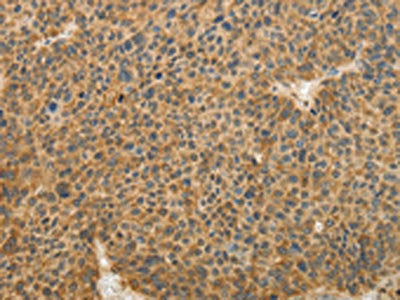 The image on the left is immunohistochemistry of paraffin-embedded Human liver cancer tissue using CSB-PA913011(TFPI2 Antibody) at dilution 1/30, on the right is treated with fusion protein. (Original magnification: ×200)