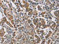 The image on the left is immunohistochemistry of paraffin-embedded Human breast cancer tissue using CSB-PA913264(CYP4A11 Antibody) at dilution 1/25, on the right is treated with fusion protein. (Original magnification: ×200)