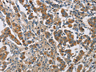 The image on the left is immunohistochemistry of paraffin-embedded Human breast cancer tissue using CSB-PA913264(CYP4A11 Antibody) at dilution 1/25, on the right is treated with fusion protein. (Original magnification: ×200)