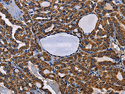 The image on the left is immunohistochemistry of paraffin-embedded Human thyroid cancer tissue using CSB-PA913546(ADRBK2 Antibody) at dilution 1/50, on the right is treated with fusion protein. (Original magnification: ×200)