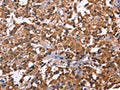 The image on the left is immunohistochemistry of paraffin-embedded Human thyroid cancer tissue using CSB-PA914015(NOS2 Antibody) at dilution 1/30, on the right is treated with fusion protein. (Original magnification: ×200)