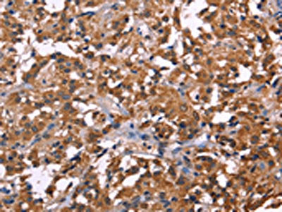 The image on the left is immunohistochemistry of paraffin-embedded Human thyroid cancer tissue using CSB-PA914015(NOS2 Antibody) at dilution 1/30, on the right is treated with fusion protein. (Original magnification: ×200)