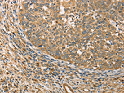 The image on the left is immunohistochemistry of paraffin-embedded Human cervical cancer tissue using CSB-PA914063(ATG3 Antibody) at dilution 1/40, on the right is treated with fusion protein. (Original magnification: ×200)