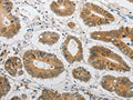 The image on the left is immunohistochemistry of paraffin-embedded Human colon cancer tissue using CSB-PA914116(LEPR Antibody) at dilution 1/20, on the right is treated with synthetic peptide. (Original magnification: ×200)