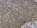 The image on the left is immunohistochemistry of paraffin-embedded Human lung cancer tissue using CSB-PA914299(IMPDH2 Antibody) at dilution 1/60, on the right is treated with fusion protein. (Original magnification: ×200)