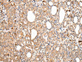 The image on the left is immunohistochemistry of paraffin-embedded Human thyroid cancer tissue using CSB-PA914369(AXIN1  Antibody) at dilution 1/30, on the right is treated with synthetic peptide. (Original magnification: ×200)