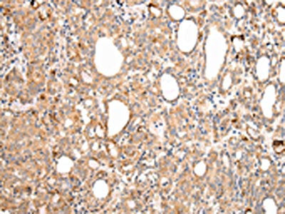 The image on the left is immunohistochemistry of paraffin-embedded Human thyroid cancer tissue using CSB-PA914369(AXIN1  Antibody) at dilution 1/30, on the right is treated with synthetic peptide. (Original magnification: ×200)