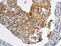 The image on the left is immunohistochemistry of paraffin-embedded Human breast cancer tissue using CSB-PA914467(ABCC3 Antibody) at dilution 1/20, on the right is treated with synthetic peptide. (Original magnification: ×200)
