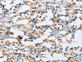 The image on the left is immunohistochemistry of paraffin-embedded Human thyroid cancer tissue using CSB-PA914618(MSH5 Antibody) at dilution 1/30, on the right is treated with fusion protein. (Original magnification: ×200)