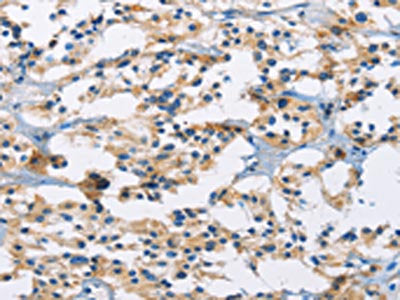 The image on the left is immunohistochemistry of paraffin-embedded Human thyroid cancer tissue using CSB-PA914618(MSH5 Antibody) at dilution 1/30, on the right is treated with fusion protein. (Original magnification: ×200)