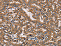 The image on the left is immunohistochemistry of paraffin-embedded Human thyroid cancer tissue using CSB-PA914699(HTR3C Antibody) at dilution 1/40, on the right is treated with fusion protein. (Original magnification: ×200)