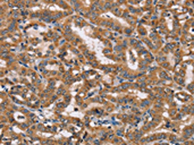 The image on the left is immunohistochemistry of paraffin-embedded Human thyroid cancer tissue using CSB-PA914699(HTR3C Antibody) at dilution 1/40, on the right is treated with fusion protein. (Original magnification: ×200)