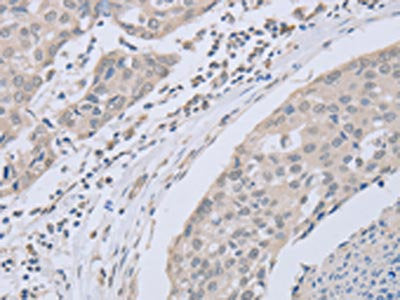 The image on the left is immunohistochemistry of paraffin-embedded Human breast cancer tissue using CSB-PA914946(ABLIM1 Antibody) at dilution 1/30, on the right is treated with fusion protein. (Original magnification: ×200)