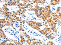 The image on the left is immunohistochemistry of paraffin-embedded Human lung cancer tissue using CSB-PA915341(LYVE1 Antibody) at dilution 1/15, on the right is treated with fusion protein. (Original magnification: ×200)