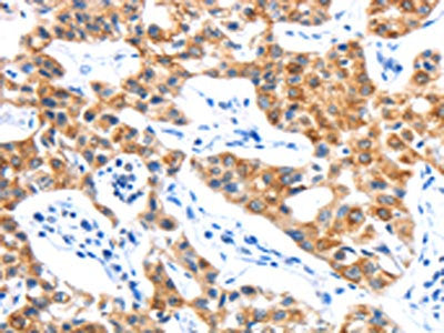 The image on the left is immunohistochemistry of paraffin-embedded Human lung cancer tissue using CSB-PA915341(LYVE1 Antibody) at dilution 1/15, on the right is treated with fusion protein. (Original magnification: ×200)