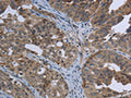 The image on the left is immunohistochemistry of paraffin-embedded Human ovarian cancer tissue using CSB-PA915371(EPHA10 Antibody) at dilution 1/20, on the right is treated with fusion protein. (Original magnification: ×200)