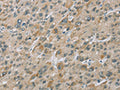 The image on the left is immunohistochemistry of paraffin-embedded Human liver cancer tissue using CSB-PA915667(EIF5 Antibody) at dilution 1/25, on the right is treated with fusion protein. (Original magnification: ×200)