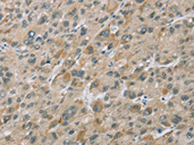 The image on the left is immunohistochemistry of paraffin-embedded Human liver cancer tissue using CSB-PA915667(EIF5 Antibody) at dilution 1/25, on the right is treated with fusion protein. (Original magnification: ×200)
