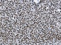 The image on the left is immunohistochemistry of paraffin-embedded Human lung cancer tissue using CSB-PA916076(CMTM2 Antibody) at dilution 1/60, on the right is treated with fusion protein. (Original magnification: ×200)