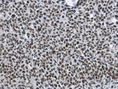 The image on the left is immunohistochemistry of paraffin-embedded Human lung cancer tissue using CSB-PA916076(CMTM2 Antibody) at dilution 1/60, on the right is treated with fusion protein. (Original magnification: ×200)